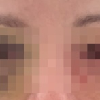 女性「目の下のクマ気になるから手術して取ってもらおｗ」→取り返しのつかない最悪の事態に・・・