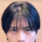 歌舞伎町のイケメンホストさんが整形手術をやった結果　ハゲてしまう・・・