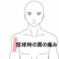 フォロースルー期に右肩がズキッと痛む中学野球部員 　登別室蘭すのさき鍼灸整骨院　症例報告