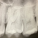 アクセス窩洞　その2