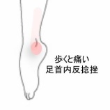 『左足首の内反捻挫後に歩行時と接地時に生じるズキンとした鋭い痛み  登別室蘭すのさき鍼灸整骨院　症例報告』の画像