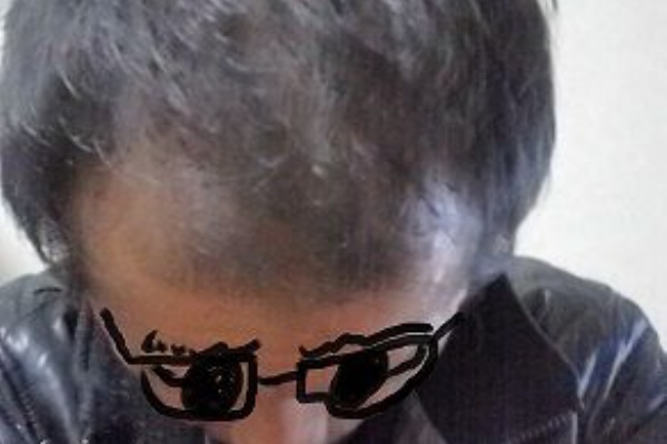 ３０代独身男 発毛に挑戦します - 若ハゲ