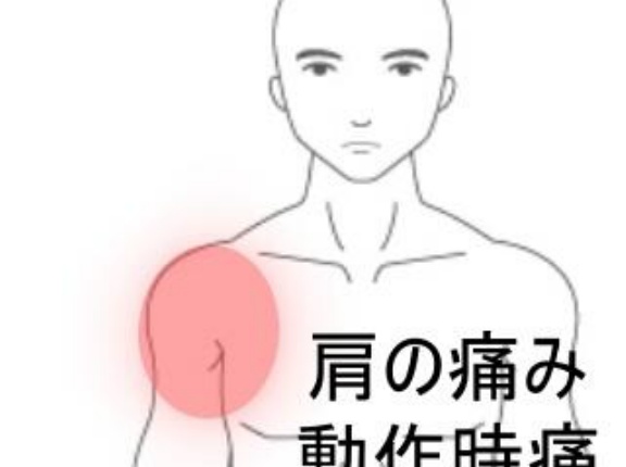 右手で左肩を触ると筋張った痛みが走る右肩前側の症状　登別室蘭すのさき鍼灸整骨院　症例報告