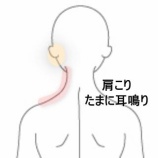 『デスクワークで悪化した左肩上部の重だるさと耳鳴り 登別室蘭すのさき鍼灸整骨院 症例報告』の画像