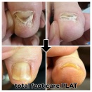 巻き爪ケア症例