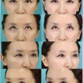 下眼瞼経結膜ハムラ法、ジュベルック、ミッドチークリフトのパーツモニターさま　術後6ヶ月