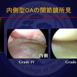 『変形性膝関節症の保存的治療と手術的治療』の画像