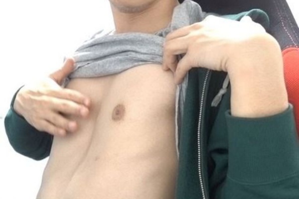 ソラリスの島 漏斗胸の男子